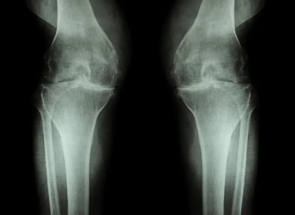 Osteoarthritis Knee ( OA Knee ) ( Film x-ray both knee with arthritis of knee joint : narrow knee joint space ) ( Medical and Science background )