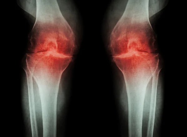 Osteoarthritis Knee ( OA Knee ) ( Film x-ray both knee with arthritis of knee joint : narrow knee joint space ) ( Medical and Science background )