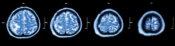 Brain tumor ( Film CT-scan of brain : show part of brain with tumor )