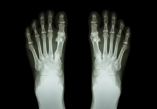 Film x-ray both foot ( front view )