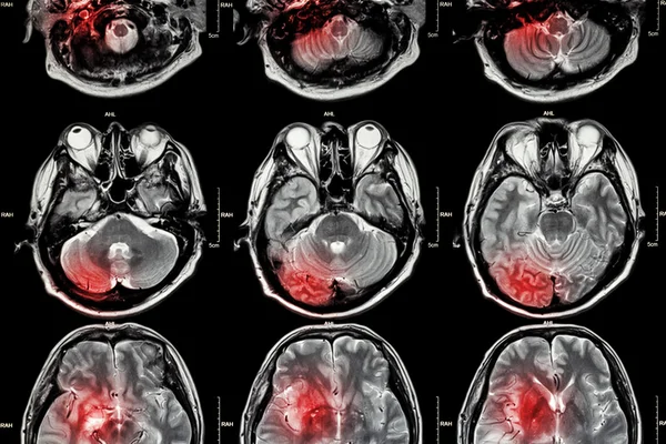 Film MRI ( Magnetic resonance imaging ) of brain ( stroke , brain tumor , cerebral infarction , intracerebral hemorrhage )  ( Medical , Health care , Science Background ) ( Cross section of brain )Fil