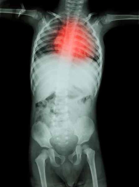 Rheumatic heart disease , Valvular heart disease  ( Film x-ray body of child with red area at heart ) ( Medical , Science and Healthcare concept )