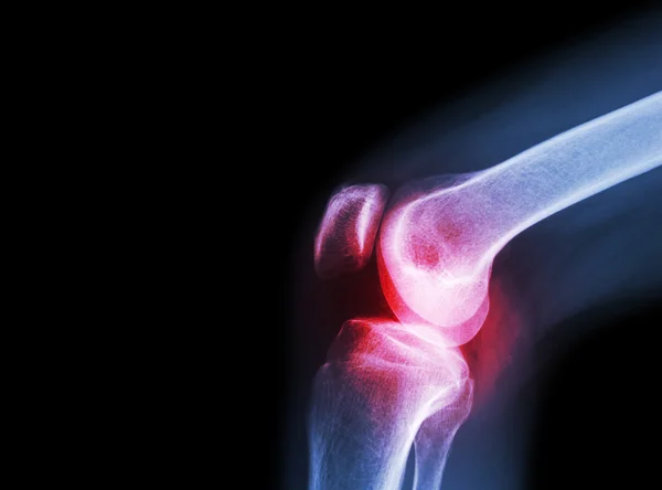 Film x-ray knee joint with arthritis ( Gout , Rheumatoid arthritis , Septic arthritis , Osteoarthritis knee ) and blank area at left side