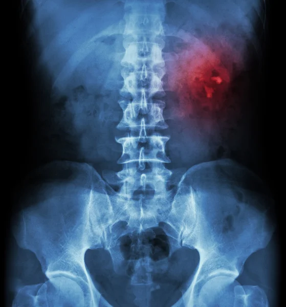 Kidney stone ( renal stone , renal calculi ) ( film x-ray KUB ( Kidney - Ureter - Bladder ) show left renal stone )