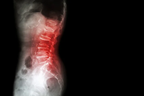 Spondylosis , Spondylolisthesis  ( Film x-ray lumbo - sacral spine show spine collapse , decrease in disc space , bony spur formation ) ( side , lateral view ) and blank area at right side