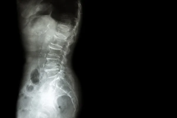 Spondylosis , Spondylolisthesis ( Film x-ray lumbo - sacral spine show spine collapse , decrease in disc space , bony spur formation ) ( side , lateral view ) and blank area at right side