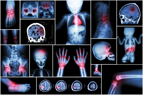 X-ray multiple part of child \'s body & multiple disease ( stroke , brain tumor , rheumatoid arthritis , sinusitis , gouty arthritis , etc)( skull chest lung heart spine arm hand pelvis leg knee foot )