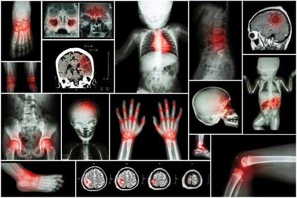 X-ray multiple part of child \'s body & multiple disease ( stroke , brain tumor , rheumatoid arthritis , sinusitis , gouty arthritis , etc)( skull chest lung heart spine arm hand pelvis leg knee foot )
