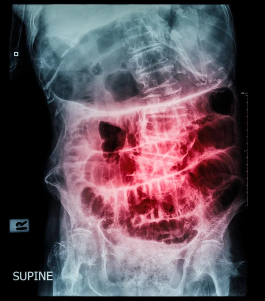 Small bowel obstruction ( film x-ray abdomen ( supine position ) : show small bowel and stomach dilate ) ( step ladder pattern )