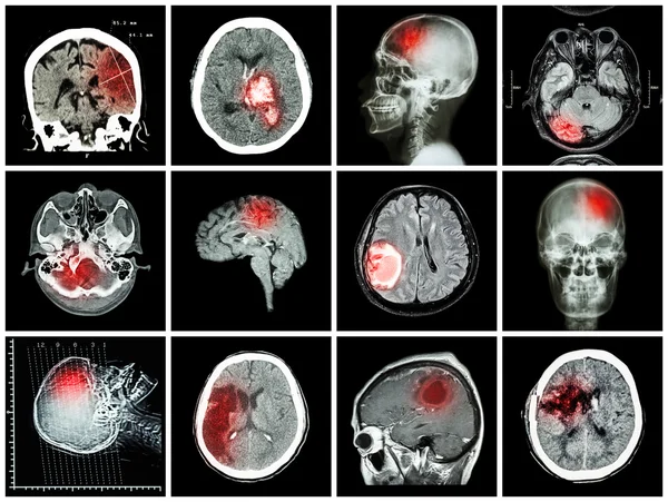 Collection of brain disease ( CT scan and MRI of brain : show cerebral infarct , intracerebral hemorrhage , brain tumor , basal ganglia hemorrhage ( status post craniotomy ) ) ( health care concept )