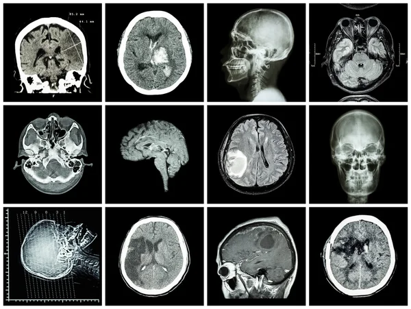 Collection of brain disease ( CT scan and MRI of brain : show cerebral infarct , intracerebral hemorrhage , brain tumor , basal ganglia hemorrhage ( status post craniotomy ) ) ( health care concept )