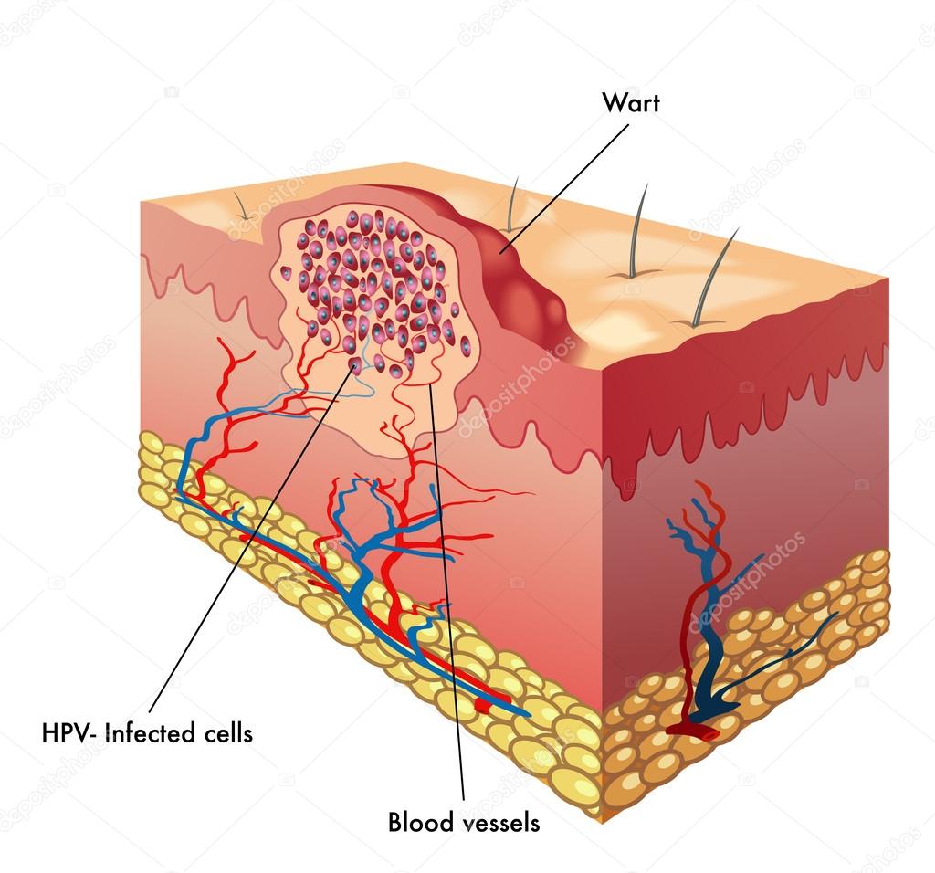 Wart & Mole Vanish | Wart, Mole, Skin Tag & Syringoma