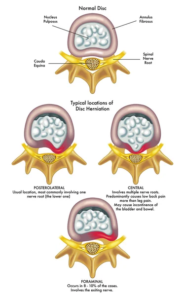 Injury to the spinal nerve