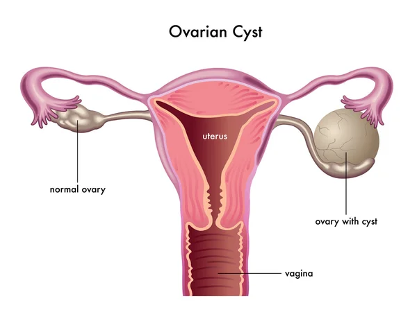 Ovarian cyst scheme