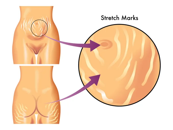 Medical illustration of symptoms of stretch marks