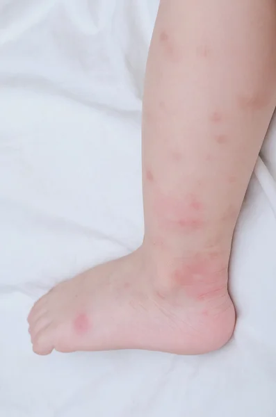 Mosquito bites sore