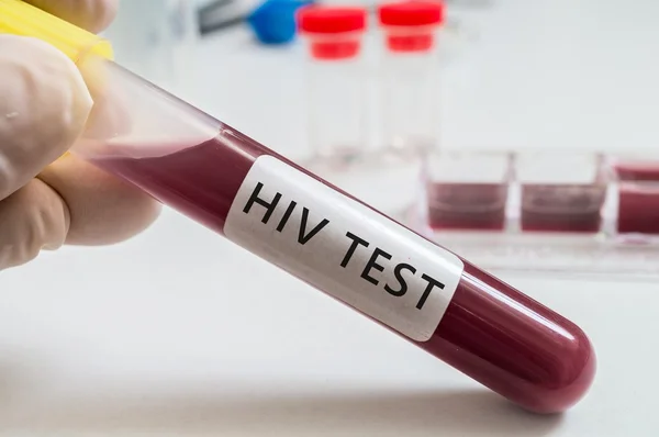 HIV test - test tube with blood in laboratory.