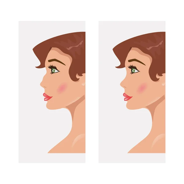 Woman before and after rhinoplasty. Vector illustration