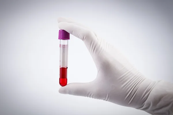 Hand holding test tube with blood plasma