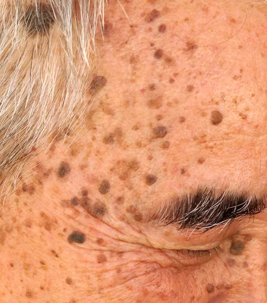 Old Asian man\'s head full of freckles