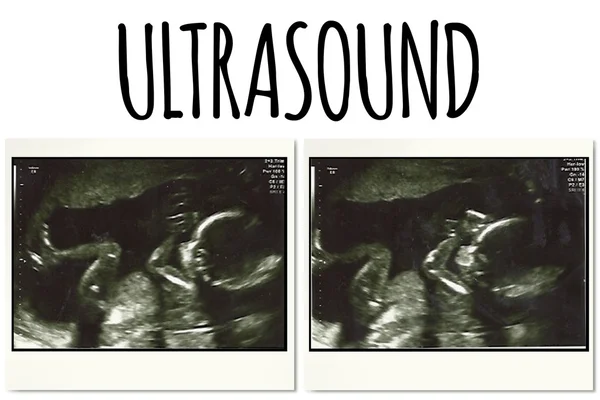 Ultrasound picture of a baby