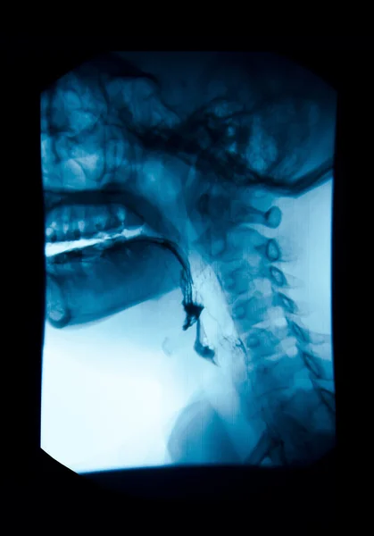 The image of x-ray upper gastrointestinal (UGI), Esophagram.