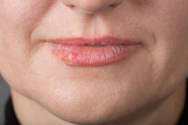 Lip infection with the herpes virus