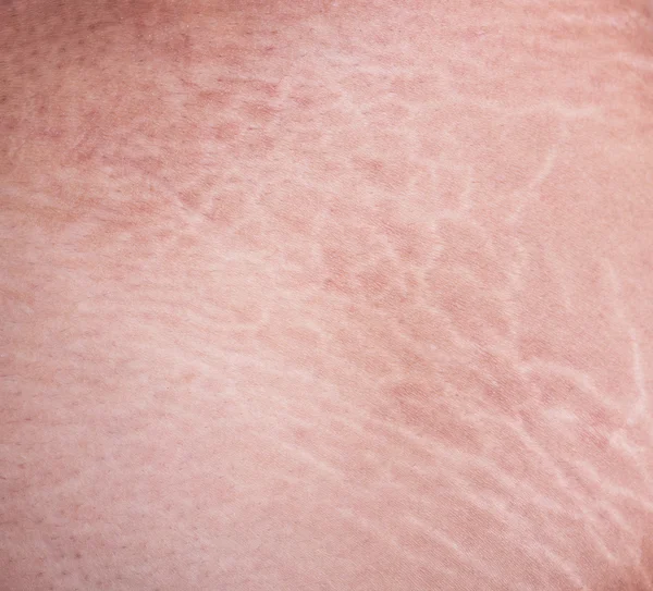 Stretch marks of skin on the thigh