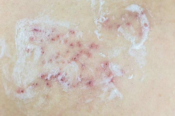 Raised red bumps and blisters on skin