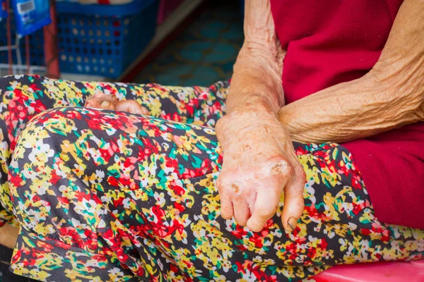 Closeup hands of old woman suffering from leprosy, amputated han