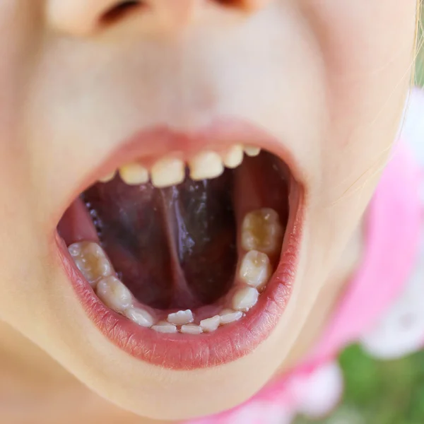 Girl six years opened his mouth and shows his teeth. Baby tooth is still not dropped, the next grew root tooth