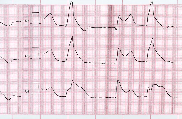 Tape ECG with macrofocal myocardial infarction and ventricular bigemia