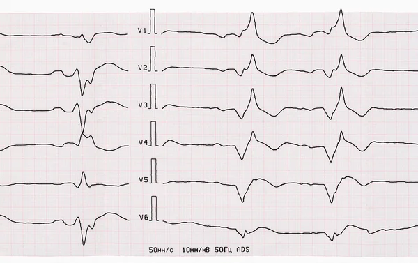 Tape ECG with acute period of myocardial infarction