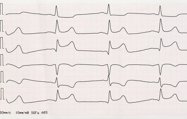 ECG with acute period of macrofocal myocardial infarction