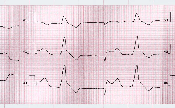 Tape ECG with macrofocal myocardial infarction and ventricular premature beats