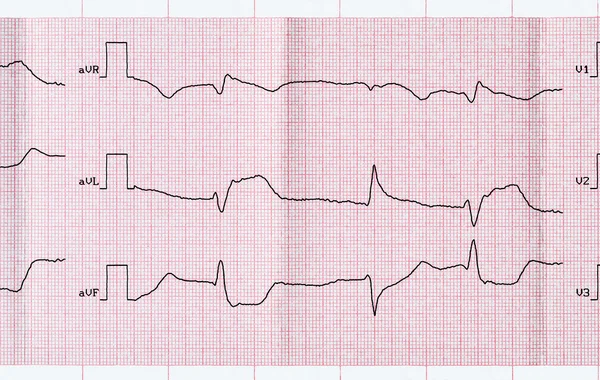 ECG with acute period macrofocal myocardial infarction and ventricular premature beats
