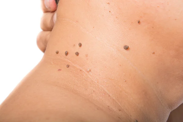 Skin of a woman with moles