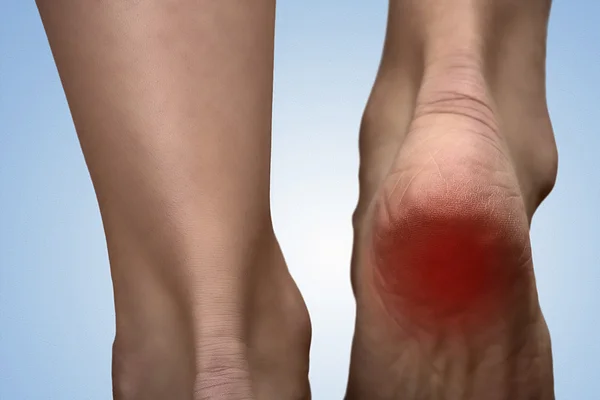 Painful heel with red spot on woman\'s foot