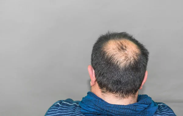 Yang man with balding.