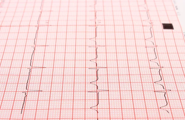 Electrocardiogram graph report