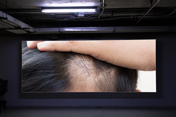 Man hair loss on advertising board in parking