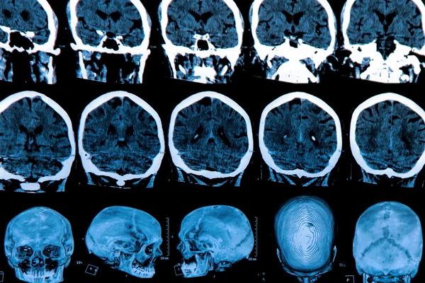 Mri Brain Scan