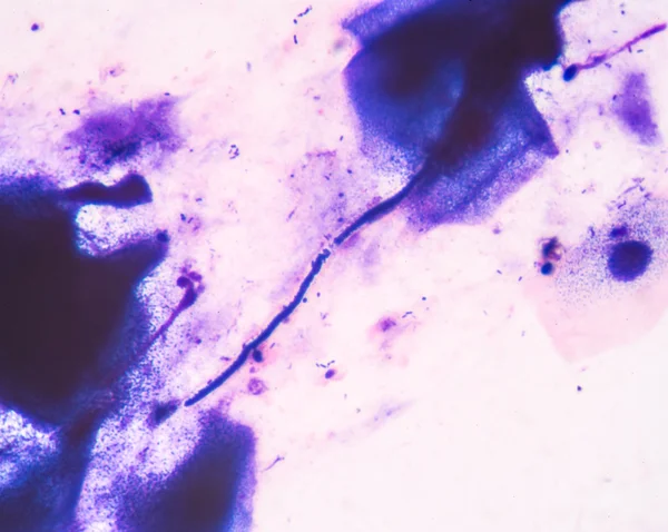Budding yeast cells with pseudohyphae from sputum gram stain tes
