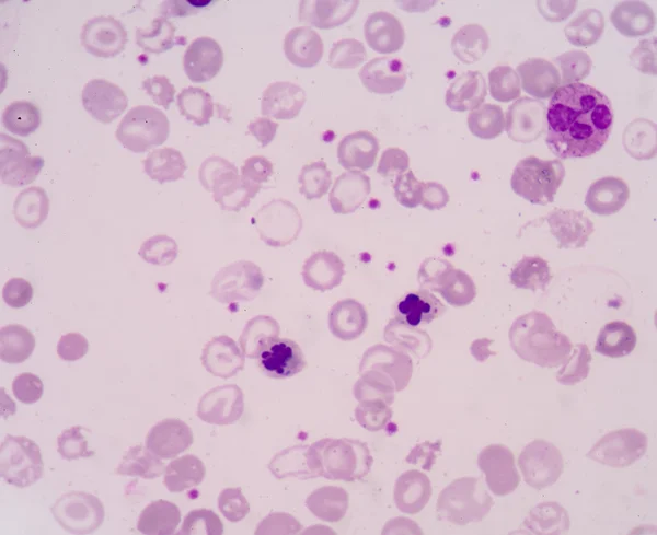 A nucleated red blood cell, or NRBC, is a red blood cell (RBC) t