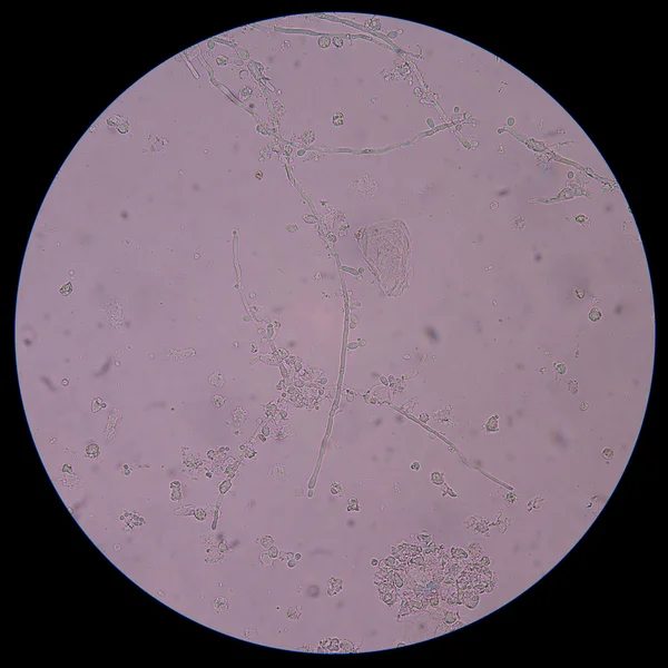 Branching budding yeast cells with pseudohyphae in urine