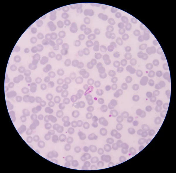 Blood smear Malaria parasite positive in thin film.