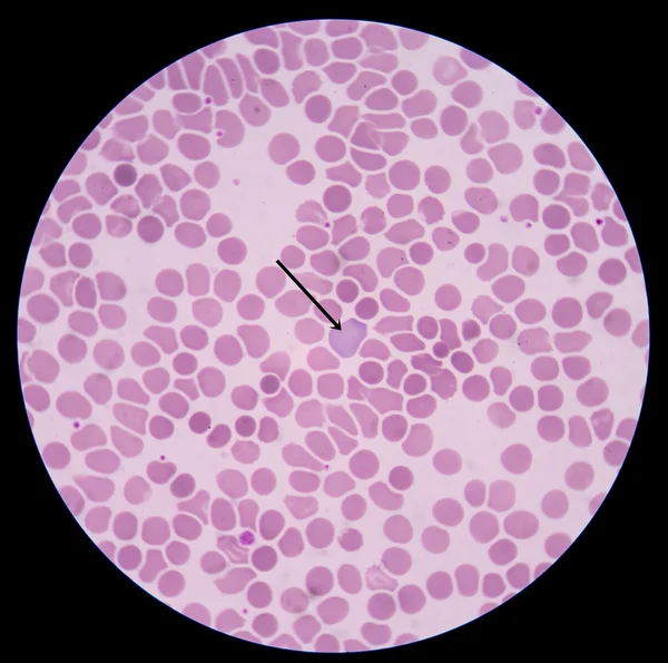 Polychromasia  is a disorder where there is an abnormally high number of red blood cells