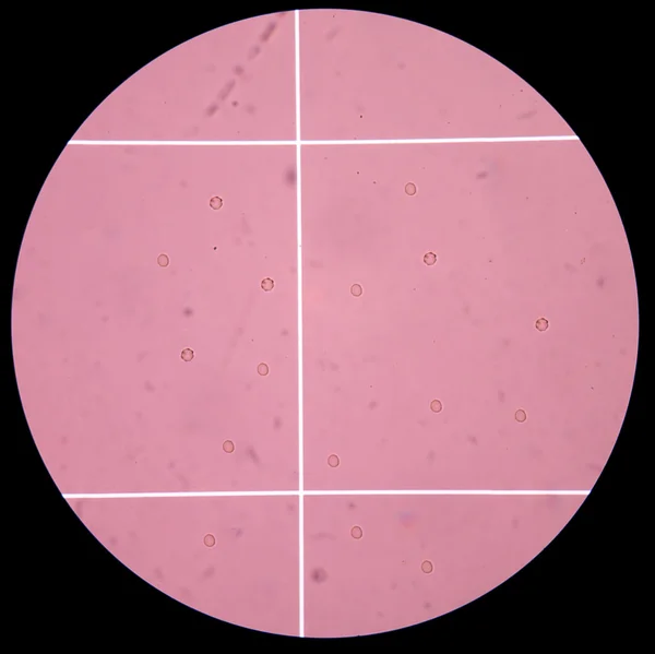 Fresh red blood cells in Cerebrospinal fluid (CSF) on scale coun