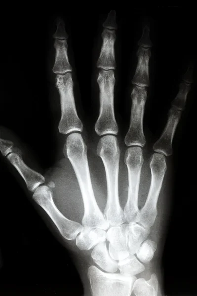 X Ray of The Right hand