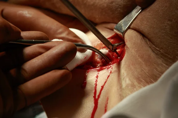 Bleeding wound during the surgery